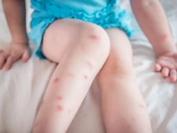 Bed bug bites — how to spot early signs of an infestation (Florida guide)
