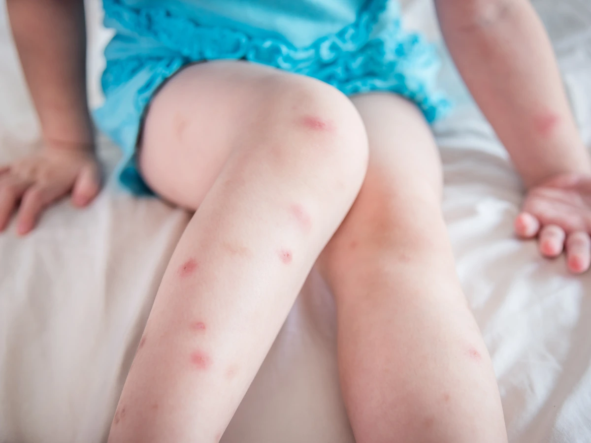 Bed bug bites — how to spot early signs of an infestation (Florida guide)